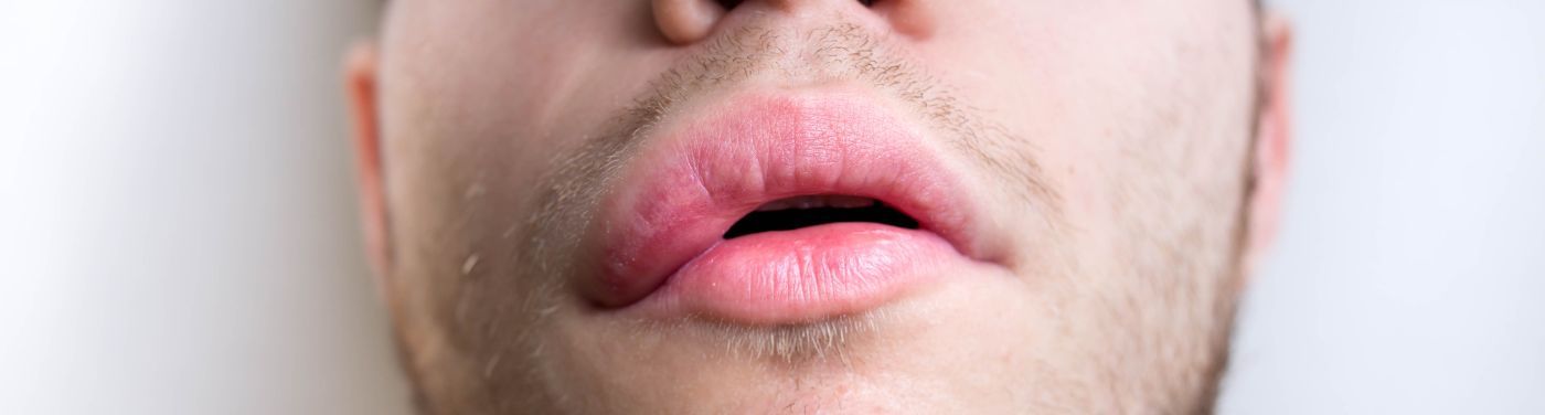 Angioedema 