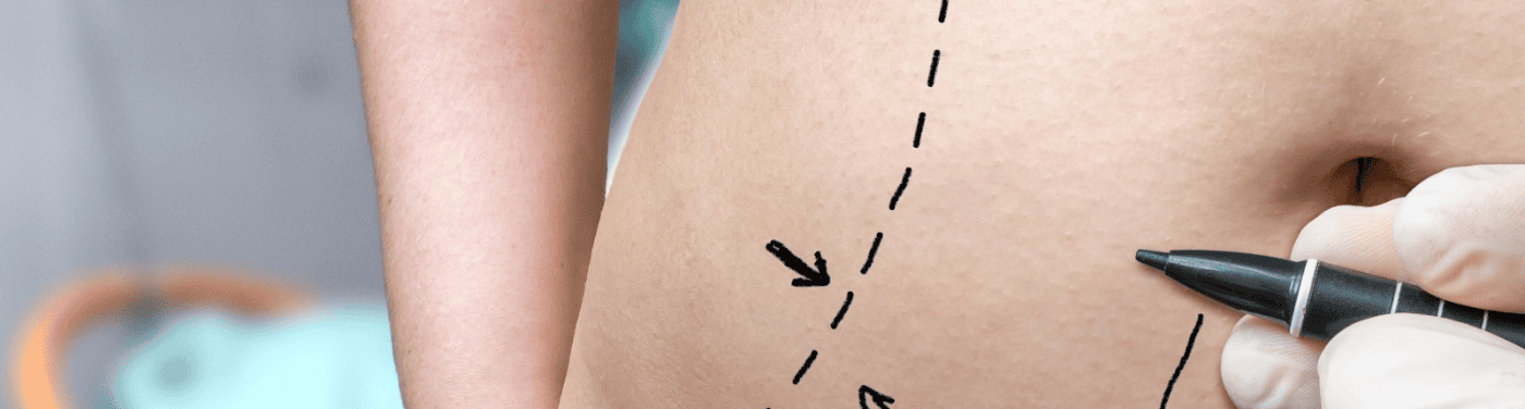 Cirurgia abdominal: quando é indicada e como funciona a preparação
