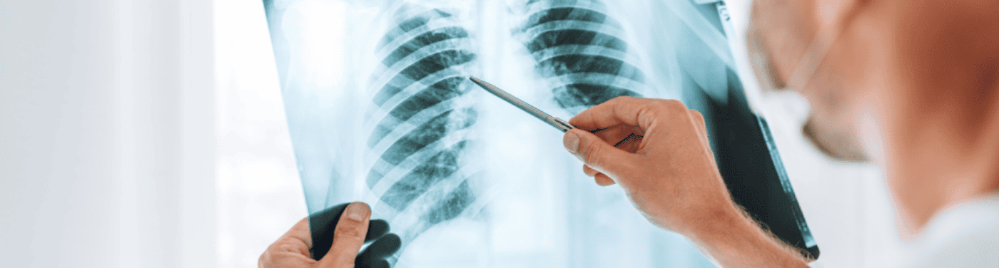 Nódulo no pulmão: causas, tipos e tratamento