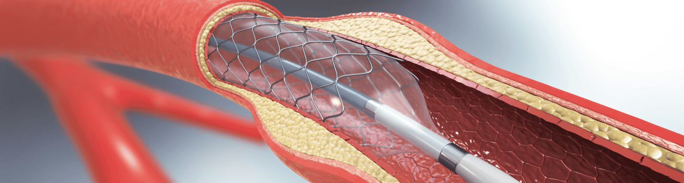 cateterismo cardiaco