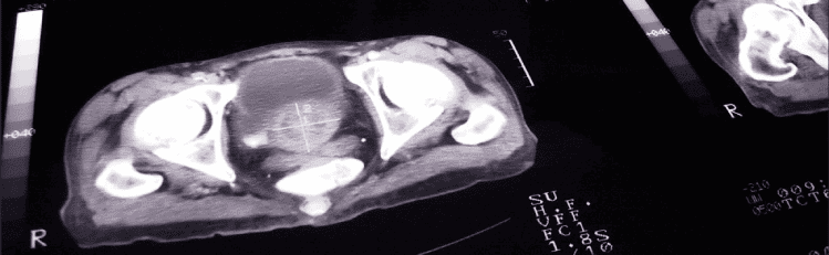 hospital-higienopolis-urologia-1300x400-cancer-de-prostata.png