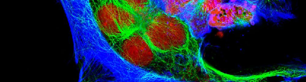 Neuroblastoma em adultos1.jpg