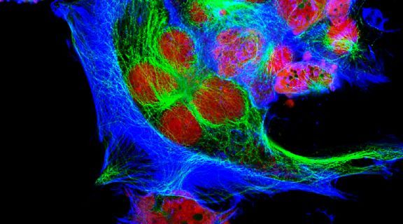 Neuroblastoma em adultos: o que é e como tratar essa condição rara