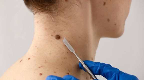 Pintas que podem ser câncer: como identificar e quando se preocupar?