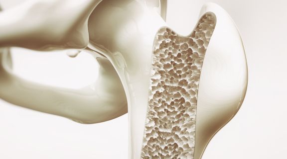Tratamento de osteoporose: cuide da saúde dos seus ossos