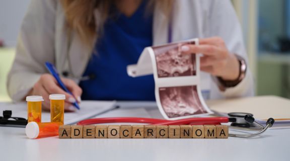 Adenocarcinoma: sintomas e tratamento disponível para a condição