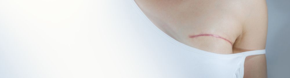 após mastectomia o câncer pode voltar1.jpg