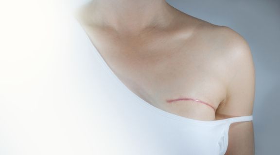 Após a mastectomia, o câncer de mama pode voltar? Entenda sobre a recidiva