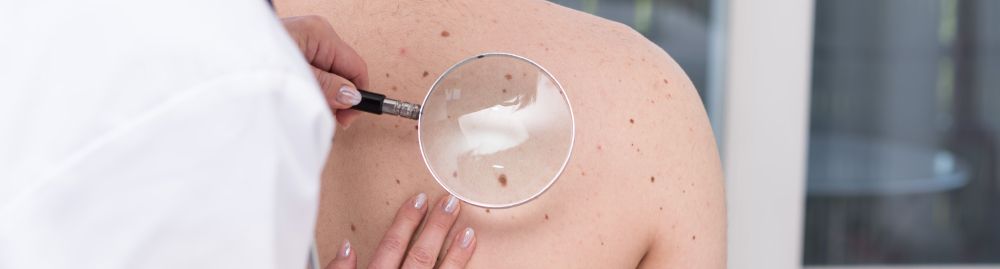 câncer de pele não melanoma1.jpg