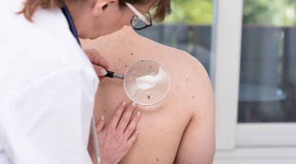   Câncer de pele não melanoma: sintomas e diagnóstico