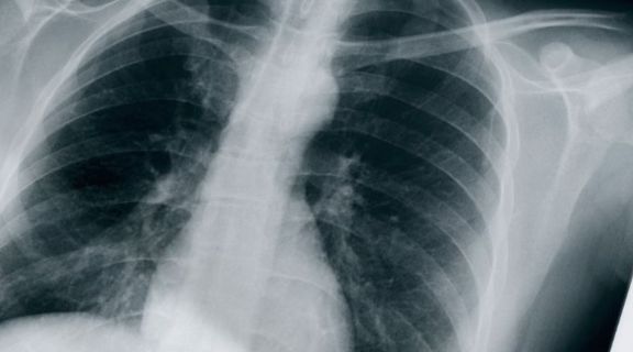 Câncer de pulmão: o tabagismo é o principal fator de risco