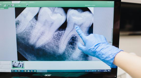   Câncer no dente existe? Entenda os sinais do câncer de boca e quando se preocupar