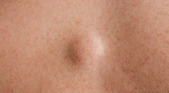 Caroço benigno: o que é, diferenças para o maligno e quando ele requer atenção médica?
