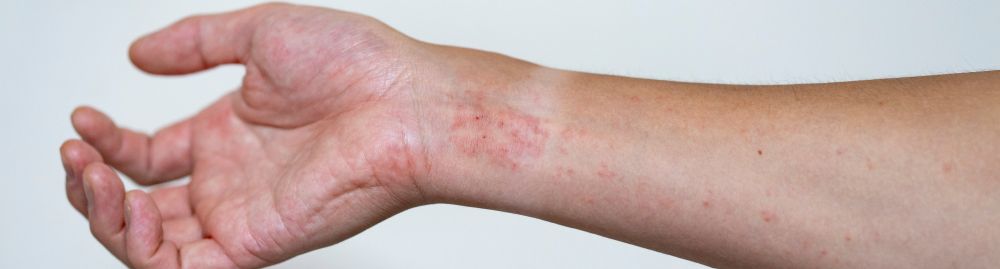 causas da dermatite atópica_1.jpg