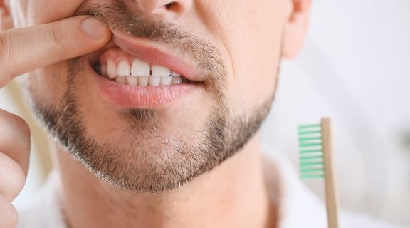 Causas da gengivite: o que causa a inflamação, fatores de risco e como tratar