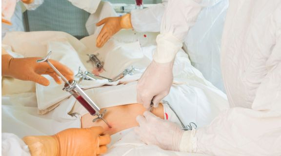 Como é feito o transplante de medula óssea: entenda os transplantes