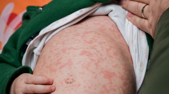 Como saber se é sarampo ou alergia: como diferenciar as manchas na pele?