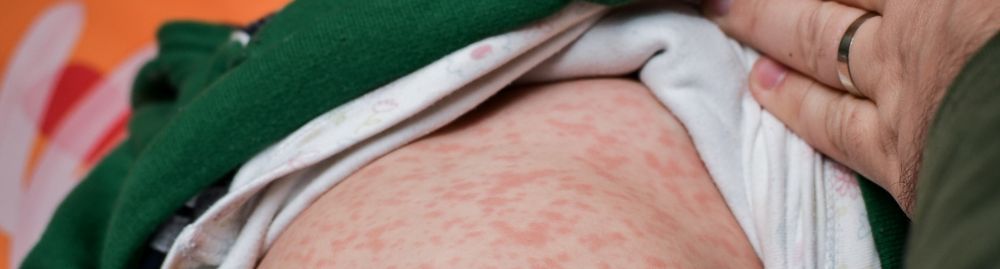 como saber se e sarampo ou alergia​1.jpg