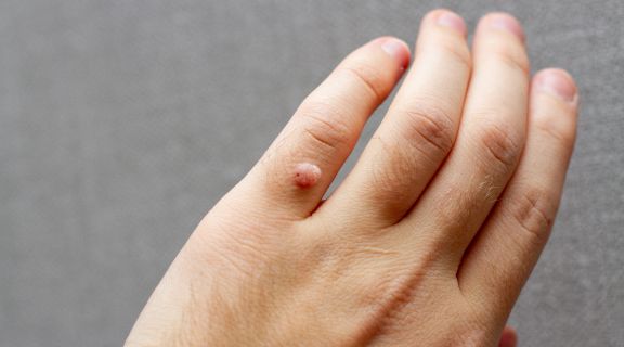 Como são as verrugas do HPV? Veja como identificar e buscar tratamento