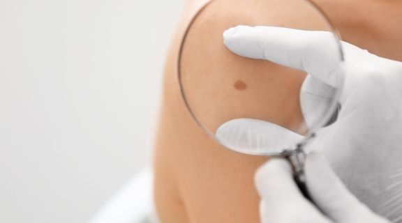Como se inicia o câncer de pele: veja quando buscar ajuda médica e como prevenir