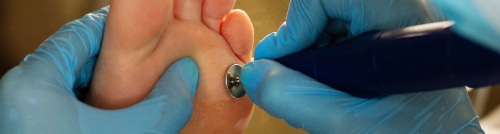 como tratar as micoses no pé1.jpg