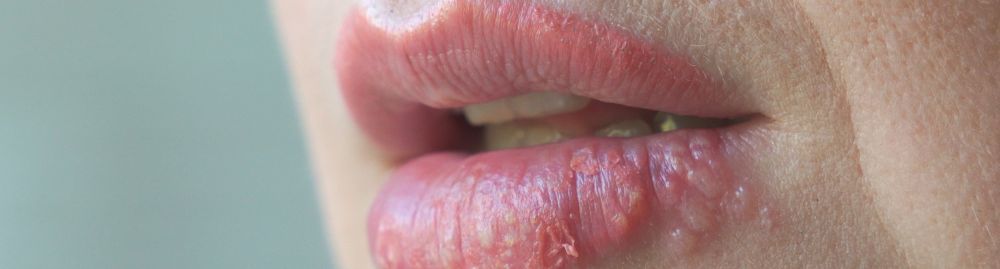 doenças transmitidas pela boca​1.jpg