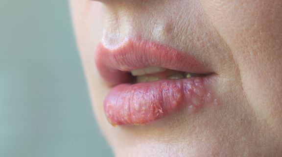 Doenças transmitidas pela boca: veja quais são as mais comuns e como se prevenir 
