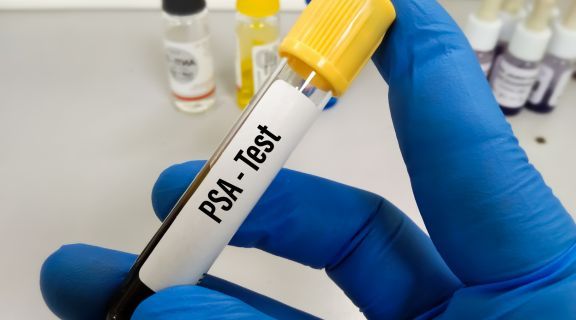   Exame de PSA: para que serve, quando é indicado e o que detecta?