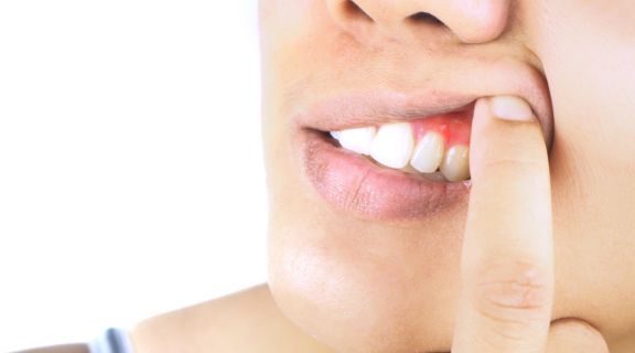 Gengivite na gravidez: entenda por que é tão comum e como você deve prevenir