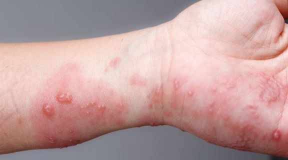 Herpes zoster é contagioso? Saiba identificar os sintomas e como prevenir