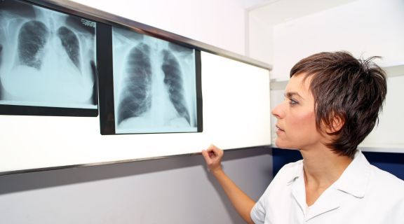 Hipertensão pulmonar é grave? Entenda os riscos e a importância do diagnóstico