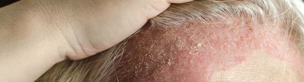 o que é bom para dermatite seborreica1.jpg