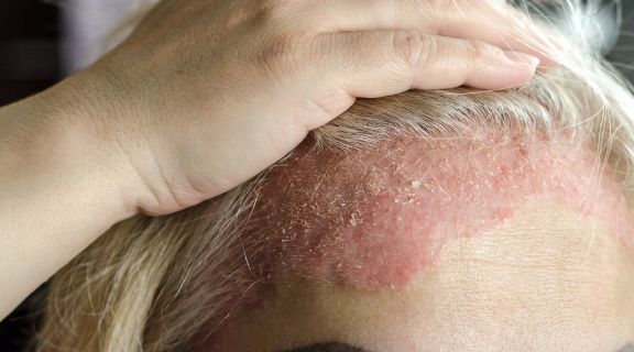 O que é bom para dermatite seborreica? Veja como controlar os sintomas