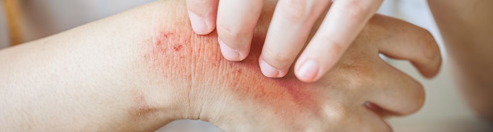 quais os tipos de alergia na pele1.jpg