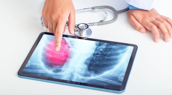   Quais são os sintomas de câncer de pulmão mais comuns?