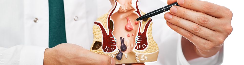 quanto tempo leva para hemorroida externa sumir_1.jpg