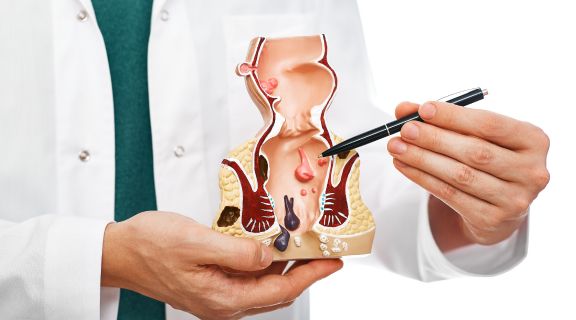 Quanto tempo leva para uma hemorroida sumir? Entenda a relação e tratamento