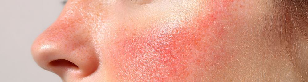 tipos de rosácea1.jpg