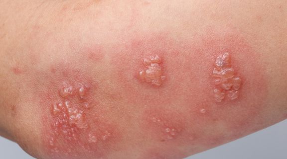 Transmissão do Herpes zoster: entenda como acontece e quando buscar um médico