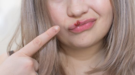   Tratamento para HPV na boca: conheça as opções e cuidados a serem tomados