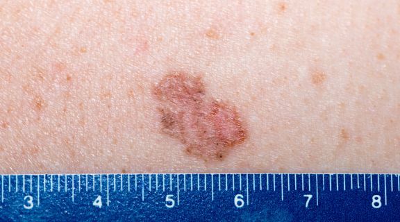 Tratamentos para carcinoma basocelular: veja os disponíveis e o que esperar