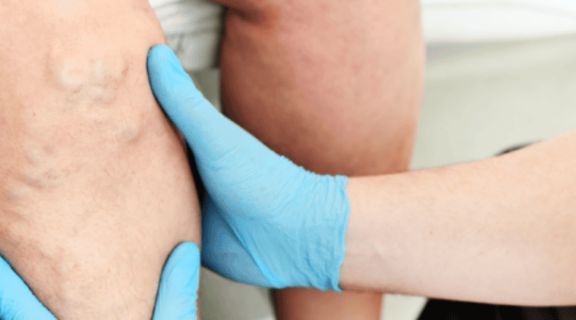 Trombose nas pernas: sintomas, diagnóstico e como tratar