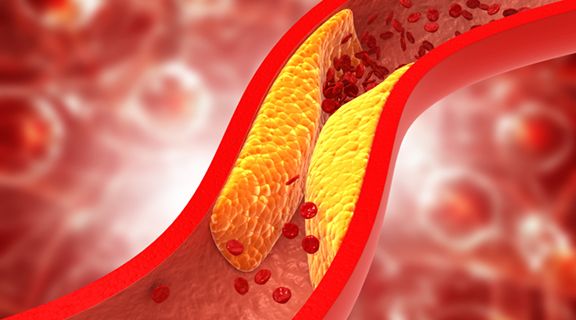 Arteriosclerose