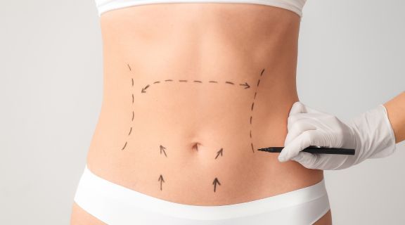 Abdominoplastia: o que é, como funciona e quando é indicada