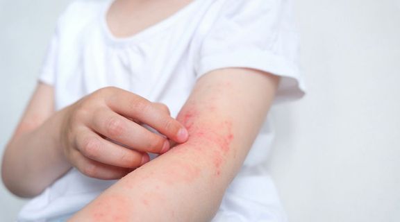 Impetigo