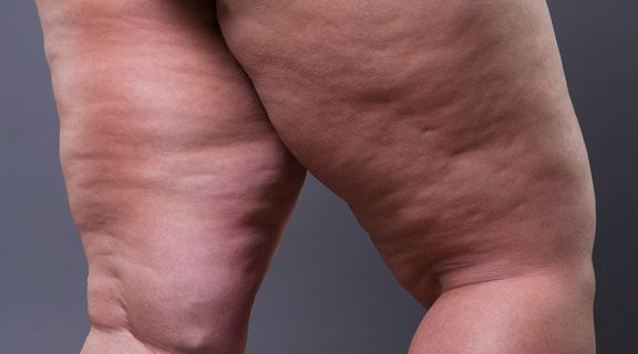 Lipedema