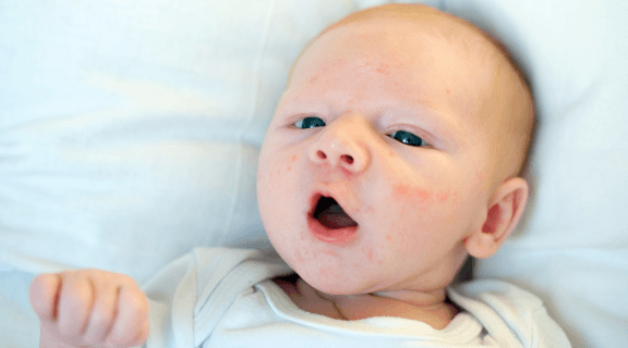 Acne neonatal: o que é?