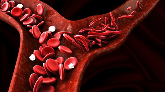 anemia falciforme