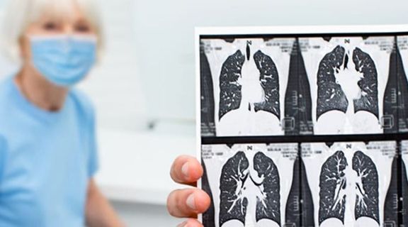 fibrose pulmonar